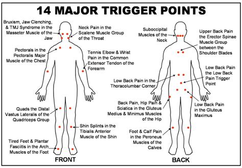 What Is Trigger Point Therapy