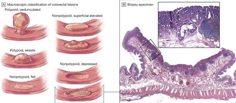 Classification Of Colorectal Lesions And Biopsy Of Lesion With