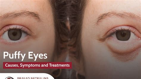Causes Symptoms And Treatments For Puffy Eyes