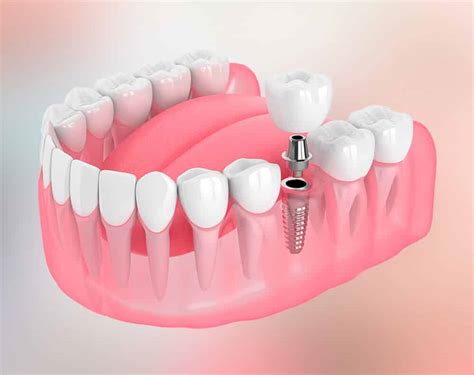 5 Star Rated Dental Implants Near The Bronx Ny