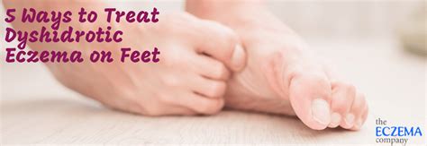 5 Ways To Treat Dyshidrotic Eczema On Feet Eczema Treatment Feet