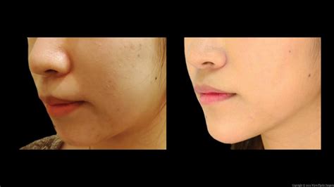 Chin Augmentation In Los Angeles And San Francisco Wave