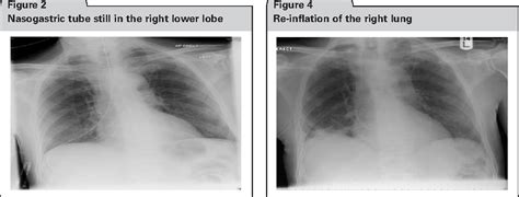 Figure 2 From Pneumothorax After Nasogastric Tube Insertion Semantic