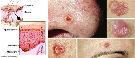 Skin Cancer Basal Cell Carcinoma P R E V I S E