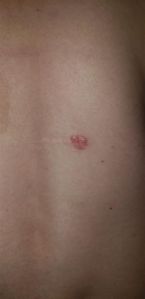 What Are These Red Raisedscaly Marks Dermatologyquestions
