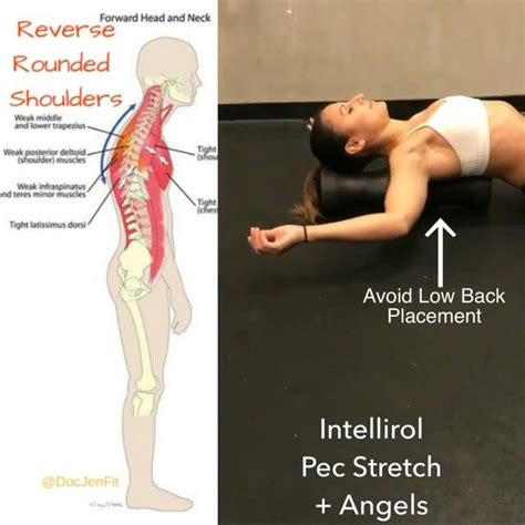Reverse Rounded Shoulders Now Protocol Will Vary Person To Person I