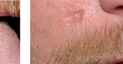Figure 1 From Syphilis On The Face In Primary Care A Rare Sign Of An