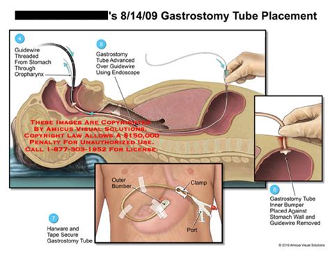 Gastrostomy Tube Placement