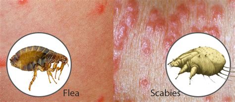 How To Tell If You Have Scabies Or Bed Bugs Bed Western