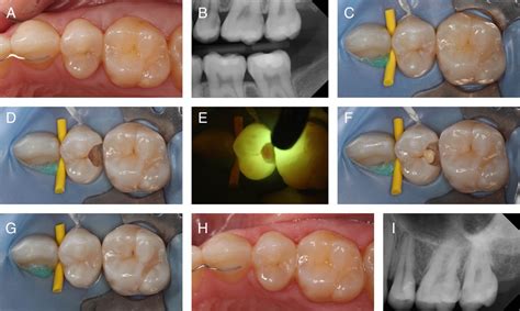 Biology Of Selective Caries Removal A Systematic Scoping Review