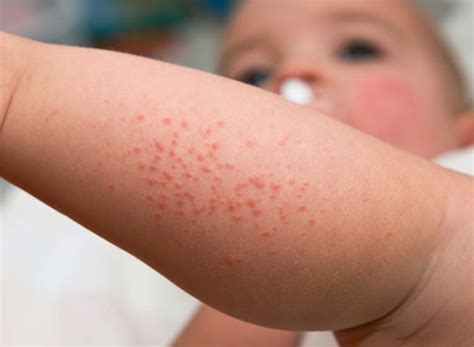 Baby Rashes Types Symptoms And More