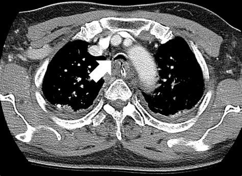 Postintubation Airway Obstruction Caused By A Retrotracheal Haematoma