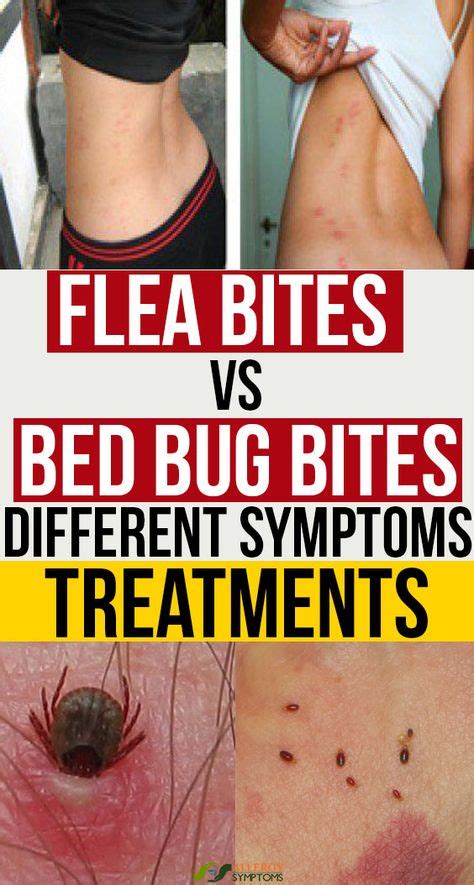 Flea Bites Vs Bed Bug Bites Different Symptoms Treatments Bed Bug