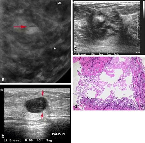 Galactocele A 35 Year Old Lactating Woman Presenting With A Palpable