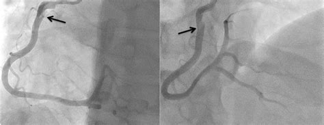 Traumatic Coronary Artery Dissection Circulation