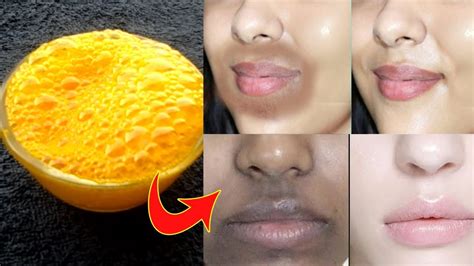 Remove Black Patches Around Mouth And Forhead Upper Lips Skin Whitening