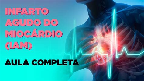 Infarto Agudo Do Miocárdio Iam Aula Completa Youtube