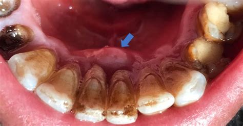 Periodontal Abscess Vs Periapical Abscess