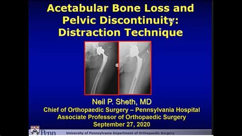 Acetabular Bone Loss In Hip Arthroplasty The Distraction Technique