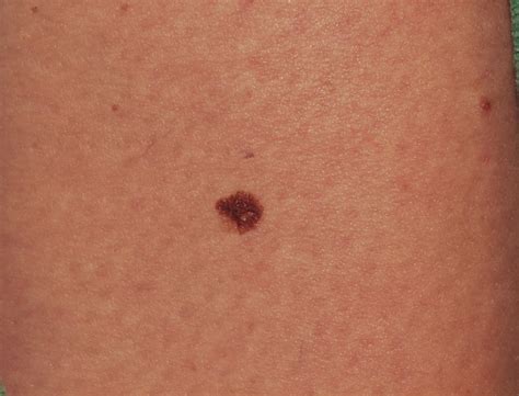Melanoma Skin Cancer Skin Cancer Melanoma Non Melanom