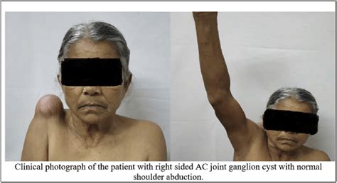 Ac Joint Ganglion Cyst Tentang Ac