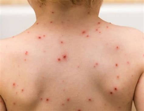 Rashes In Children May Be Caused By Some “hypoallergenic” Products