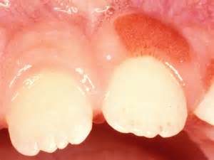Swollen Gum Around One Tooth Causes And Treatment 2022