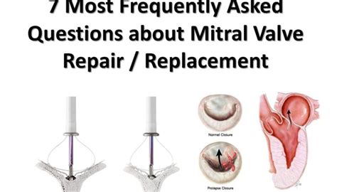 Mitral Valve Repair Surgery Cost In Hyderabad Dr Sarat