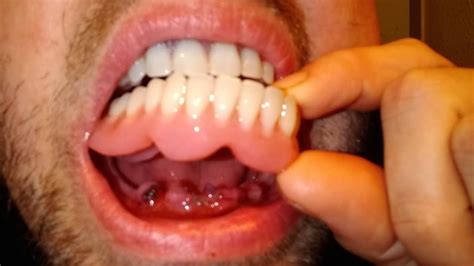 Full Mouth Extraction Immediate Dentures Pictures Huzaifahpavel