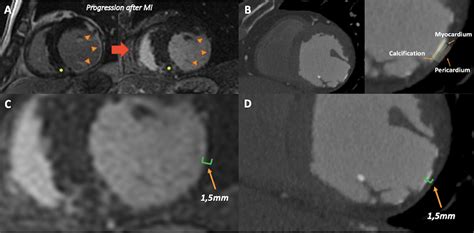 Cureus Cardiac Multimodality Imaging Assessment Of Dystrophic