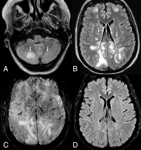 Detection Of Microhemorrhage In Posterior Reversible Encephalopathy