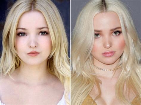 dove cameron plastic surgery lips injection before after photos my xxx hot girl