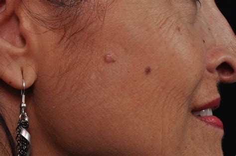 Skin Cancer Photo Gallery