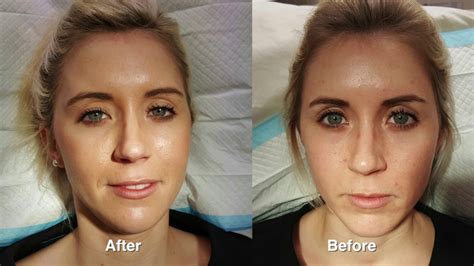 Botox Vs Filler Juvederm Rejuvenation W Before And After Pictures