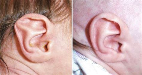Ear Molding In Northern New Jersey Correcting Newborn Ear Deformities