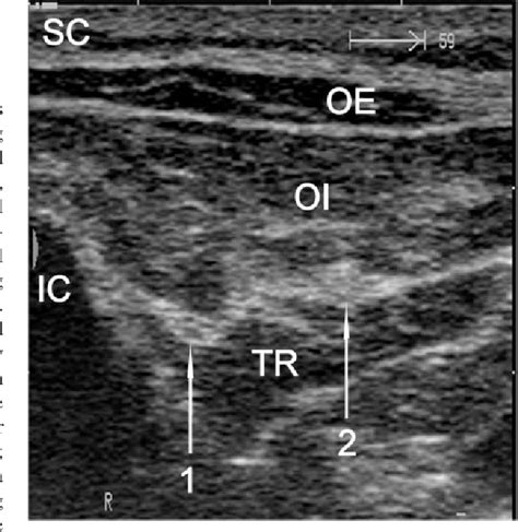 Figure 2 From Ultrasound Guided Blocks Of The Ilioinguinal And