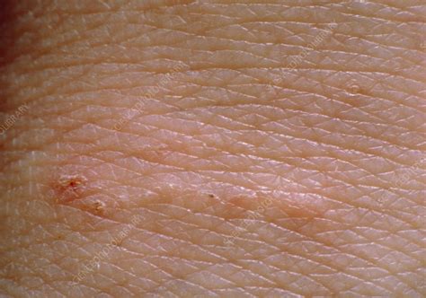 scabies rash on skin stock image m260 0040 science photo library