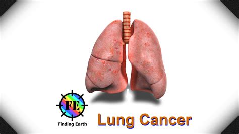 As you may have a number of symptoms, you may be given a combination of treatments. Lung Cancer - Symptom, Causes & Diagnosis (Finding Earth ...