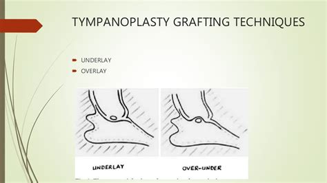 Tympanoplasty And Ossiculoplasty