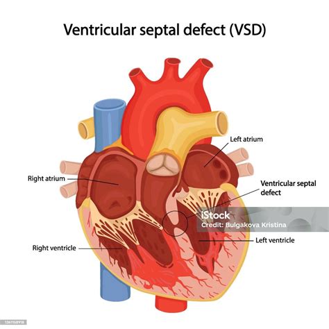 Communication Interventriculaire Malformation Cardiaque Congénitale