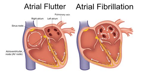 atrial flutter vs atrial fibrillation