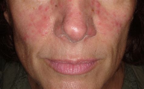 The Gut Face Connection In Rosacea Exploring The Role Of H Pylori Dermatology Advisor
