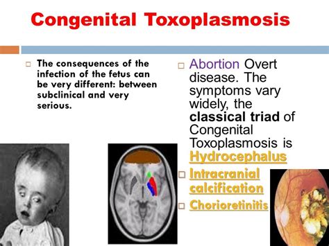 Mnemonic To Remember The Triad Of Congenital Toxoplasmosis