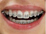 How Much Do Braces Cost With Insurance For Adults Photos