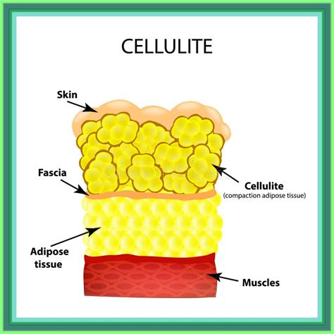 The Formation Of Cellulite Vector Diagram Stock Vector Illustration
