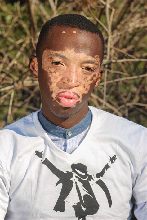 First Man To Have Vitiligo Vitiligo In South Africa Beyond Vitiligo