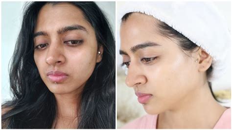 How I Got Rid Of Skin Pigmentation And Uneven Skin Tone Youtube