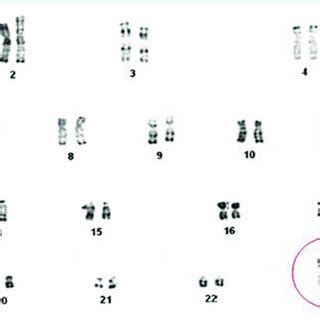 Karyotype Of A Patient With Klinefelter Syndrome XXY Download Scientific Diagram