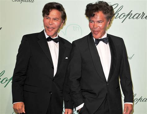 Plastic Surgery Turned Handsome French Twin Actors Into Freakish Cat People