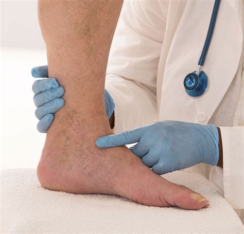 Arterial blood clots cause diseases and illnesses that are medical emergencies or call 911. Clot in ankle symptoms, IAMMRFOSTER.COM